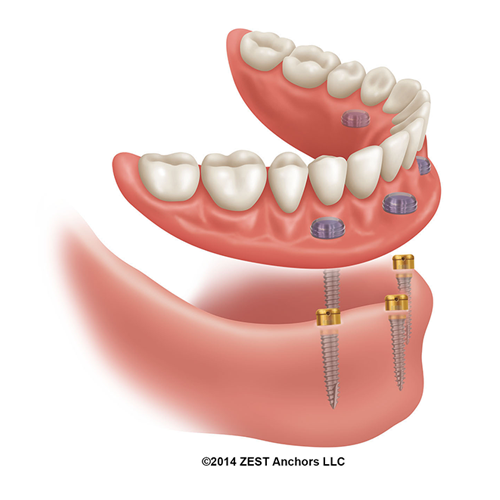 za-ndi-lodi-overdenture-copyright_1